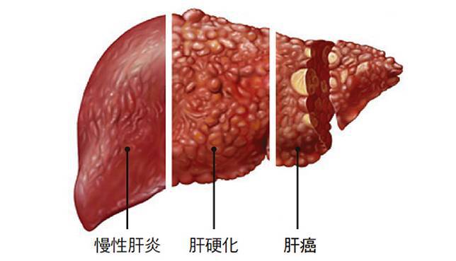 丙肝病毒量越高，是不是病情越嚴重？怎么樣判斷病情？ 